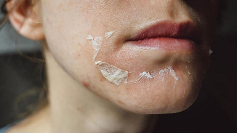 Tổng quan peel da trong trẻ hóa và điều trị da liễu