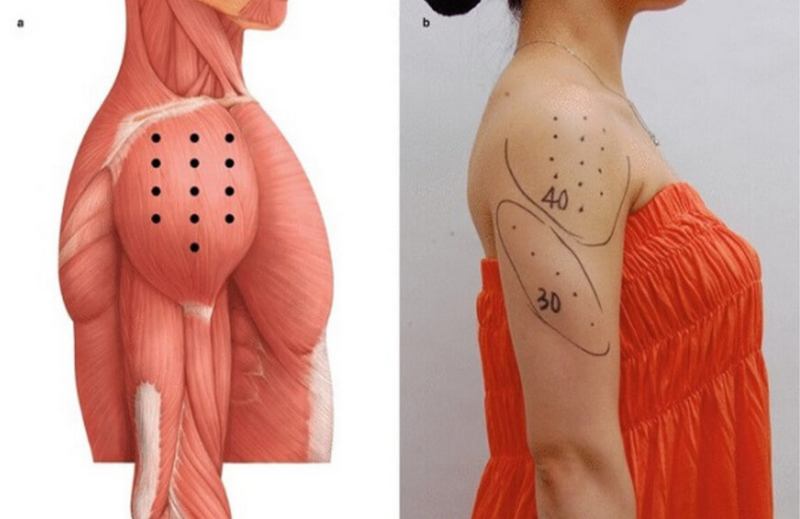 Tiêm thon gọn bắp tay giá bao nhiêu