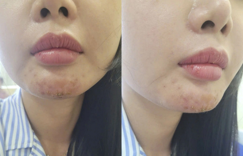 Dấu hiệu tiêm filler bị hoại tử và hướng dẫn xử lý an toàn