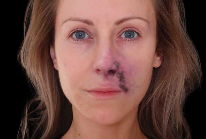 Dấu hiệu tiêm filler bị hoại tử và hướng dẫn xử lý an toàn