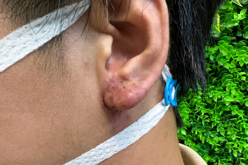 Dấu hiệu tiêm filler bị hoại tử và hướng dẫn xử lý an toàn