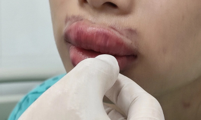 Dấu hiệu tiêm filler bị hoại tử và hướng dẫn xử lý an toàn