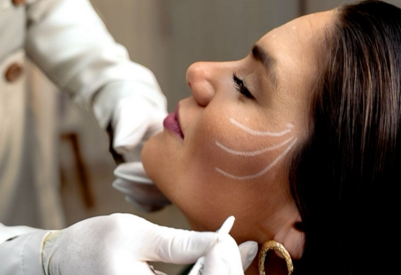 Bảng giá tiêm filler theo từng vị trí, 1cc filler giá bao nhiêu?