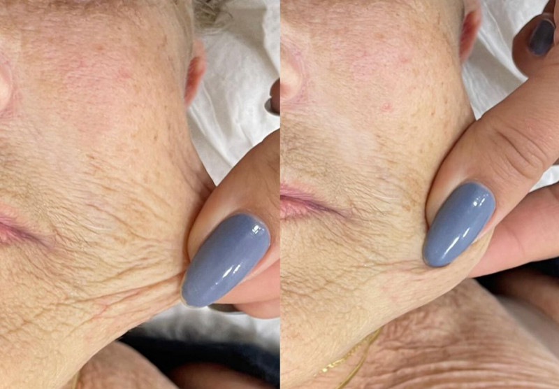 Hyaluronic axit là gì? Công dụng và cách sử dụng axit hyaluronic