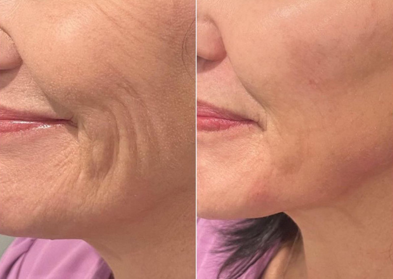 Tiêm HA có phải là filler không? Lưu ý an toàn cho người dùng