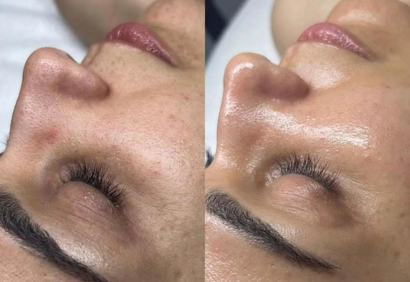 Tiêm HA có phải là filler không? Lưu ý an toàn cho người dùng