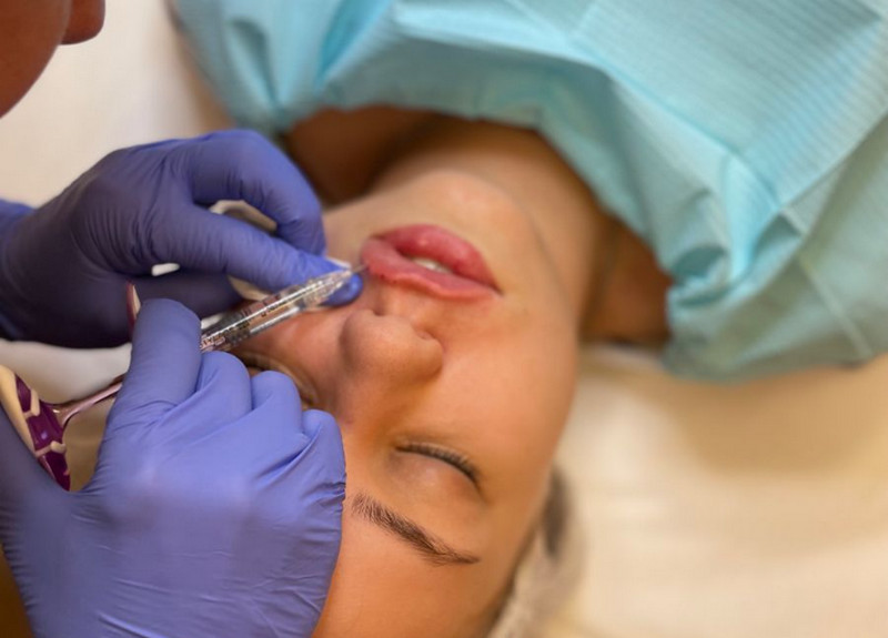 Tiêm HA là gì? Công dụng, loại HA & điểm khác biệt so với filler