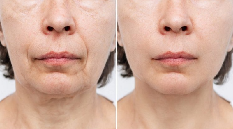 Tiêm profhilo của nước nào, giá bao nhiêu tiền?