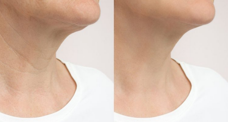 Tiêm profhilo của nước nào, giá bao nhiêu tiền?