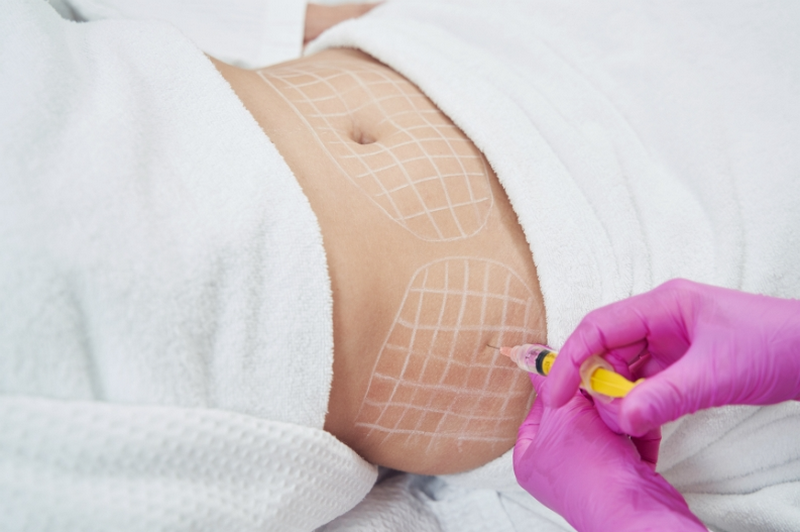 Tiêm tan mỡ là như thế nào, có an toàn không?