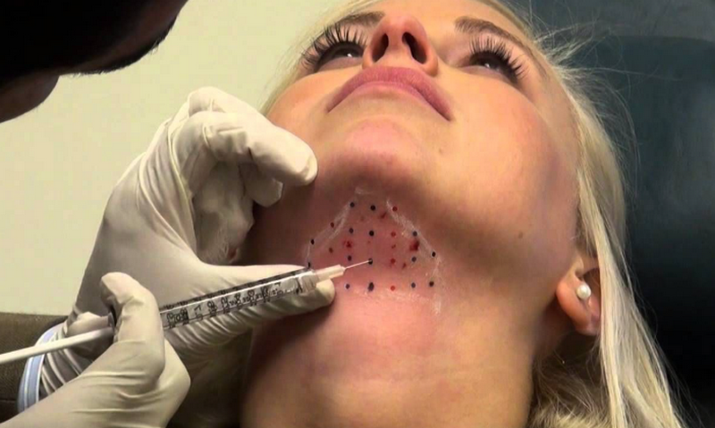 Tiêm tan mỡ là như thế nào, có an toàn không?