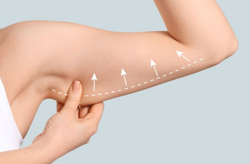 Tiêm tan mỡ là như thế nào, có an toàn không?