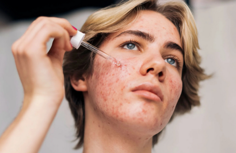 Bắn laser trị thâm được không? Chi phí bao nhiêu tiền?