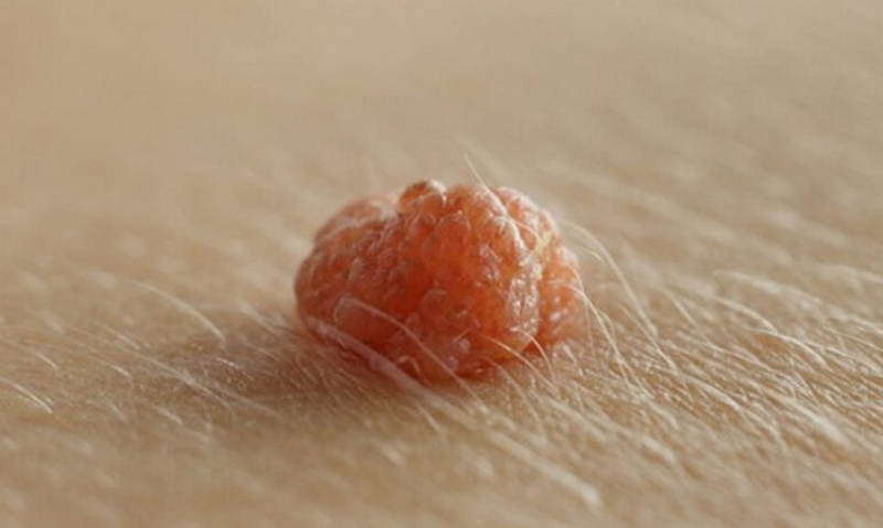 Bắn laser mụn thịt có hiệu quả không? Cách giảm tái phát là gì