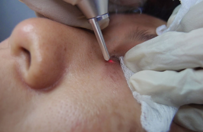 Bắn laser mụn thịt có hiệu quả không? Cách giảm tái phát là gì