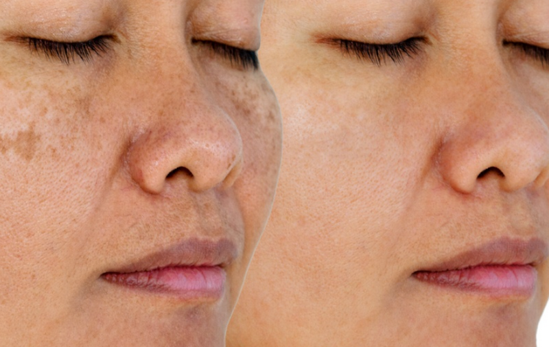 Cách chăm sóc da sau khi bắn laser trị nám