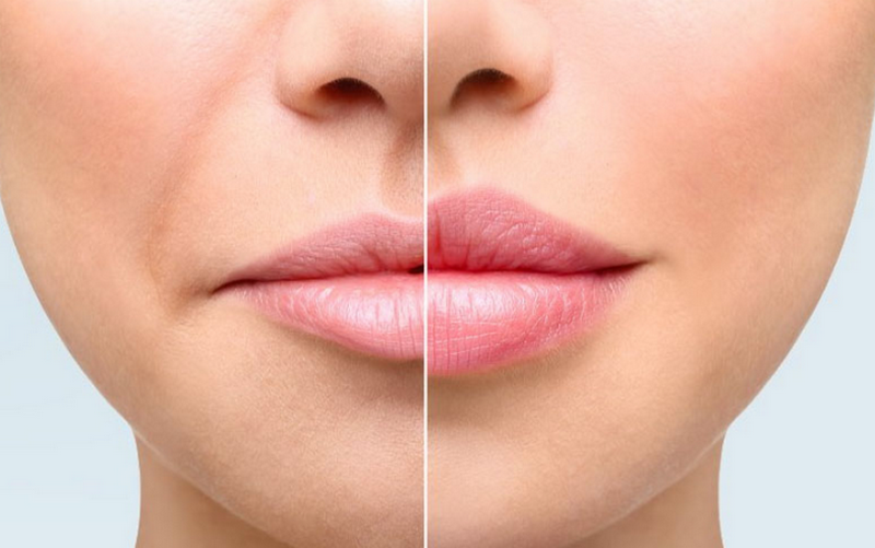 Tiêm môi bao nhiêu tiền? Bảng giá tham khảo và có đáng đầu tư không?