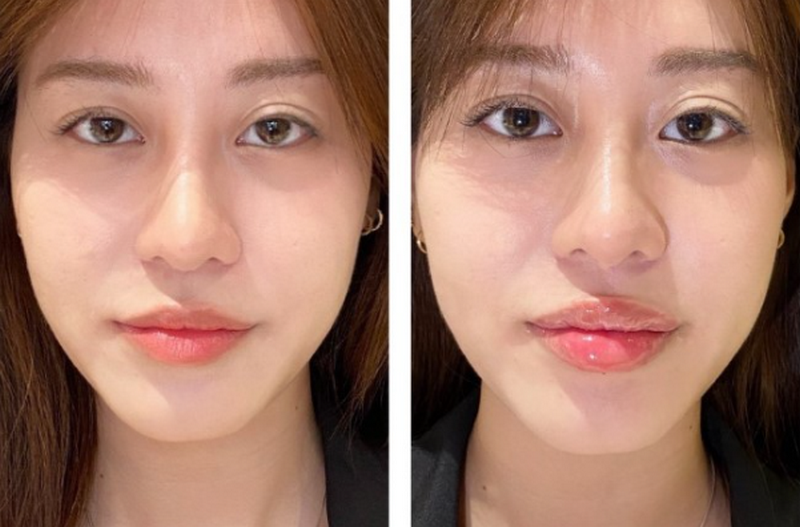 Tiêm môi bao nhiêu tiền, có nên tiêm không?