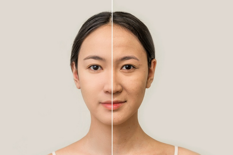 Nâng cơ mặt: Công nghệ nào hiệu quả, ưu nhược điểm và điều cần biết