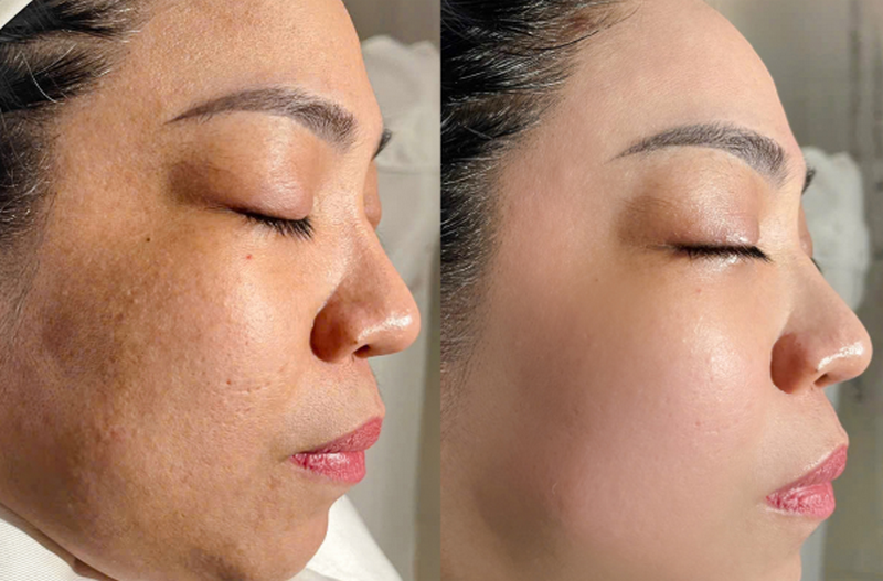 Tiêm BAP là gì? Công dụng của tiêm BAP