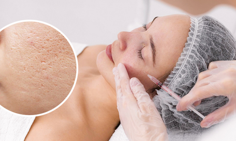 Tiêm meso bao nhiêu tiền? Bảng giá 2025 & cách chọn cơ sở uy tín