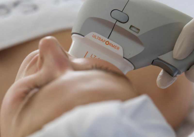 Công nghệ Ultherapy và ứng dụng nổi bật trong thẩm mỹ không xâm lấn