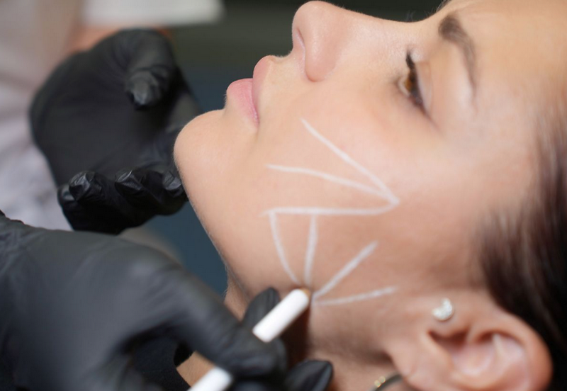 Tiêm Rejuran là gì, của nước nào và giá bao nhiêu tiền?