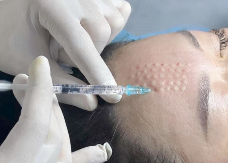 Bật mí sau tiêm meso bao lâu thì được dưỡng da