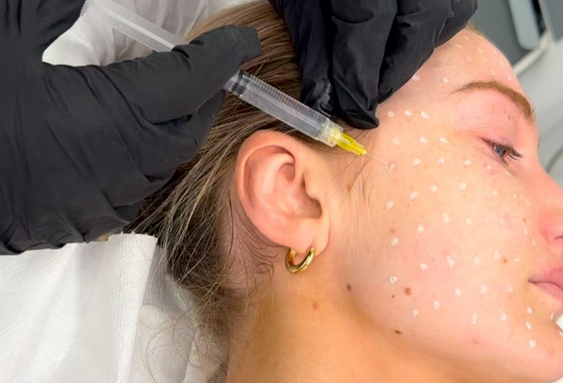 Bật mí sau tiêm meso bao lâu thì được dưỡng da