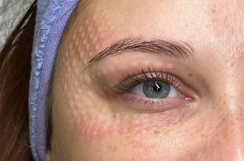 Tiêm meso Rejuran là tiêm gì? Có tốt không?