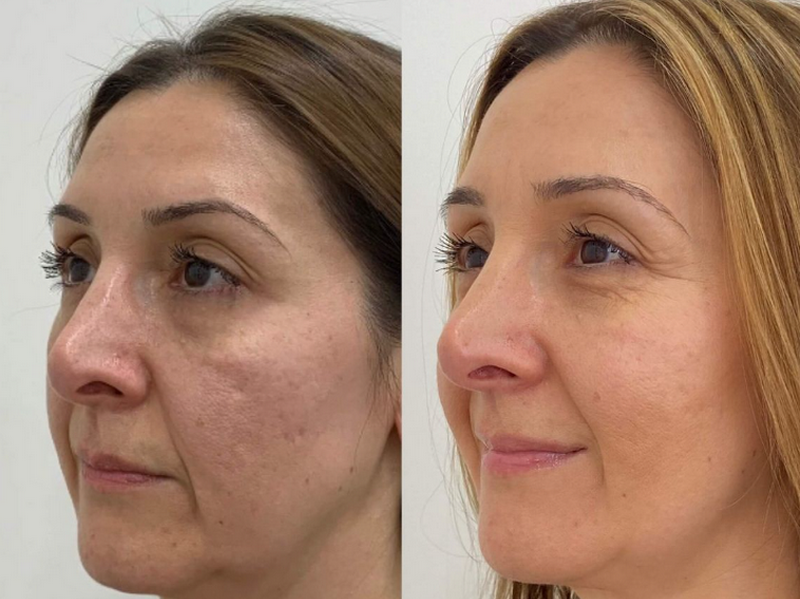 Meso Rejuran là gì? Công dụng, quy trình & liệu trình bạn nên biết