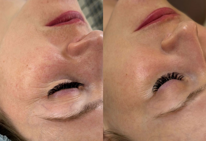 Rejuran I là gì? Công dụng và liệu trình