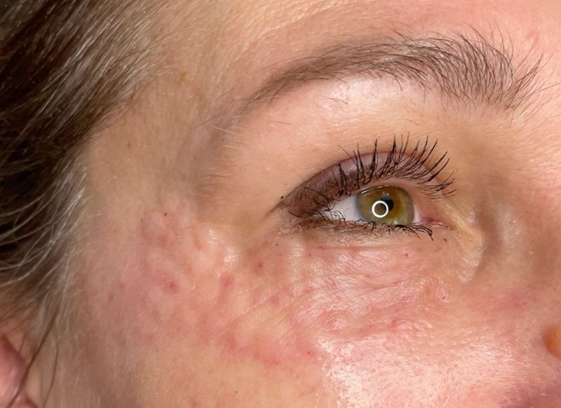 Rejuran I là gì? Công dụng và liệu trình