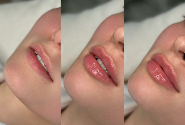 Tiêm môi là gì? Công dụng, quy trình và những điều cần biết