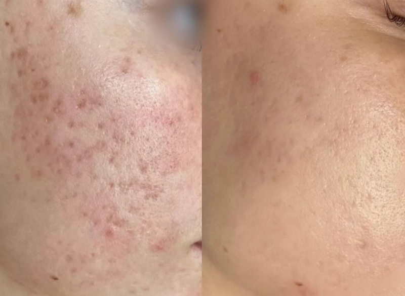 Có nên peel da không? Lợi ích, rủi ro & đánh giá từ bác sĩ