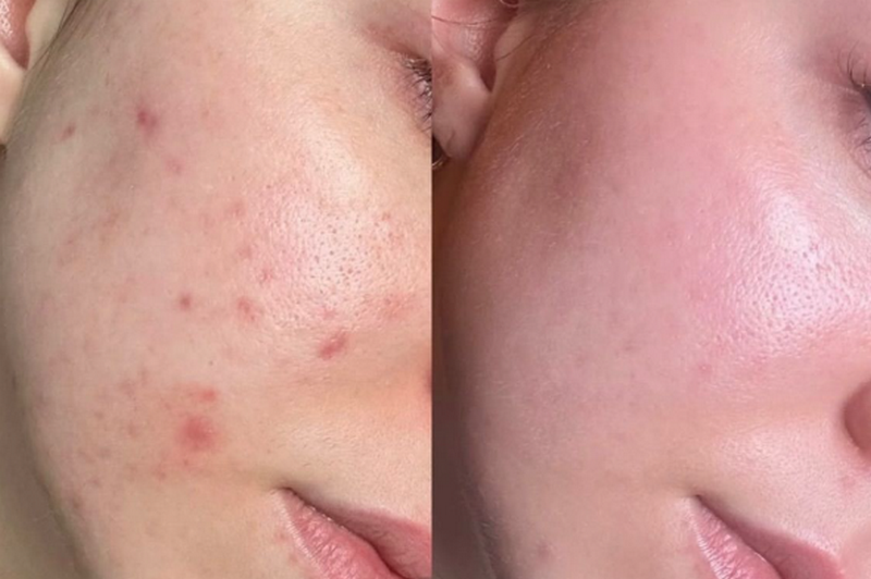 Peel da có tốt không? Ưu nhược điểm & lưu ý cần biết trước khi làm