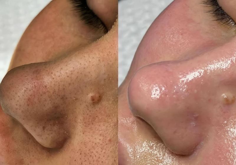 Peel da có tốt không? Ưu nhược điểm & lưu ý cần biết trước khi làm