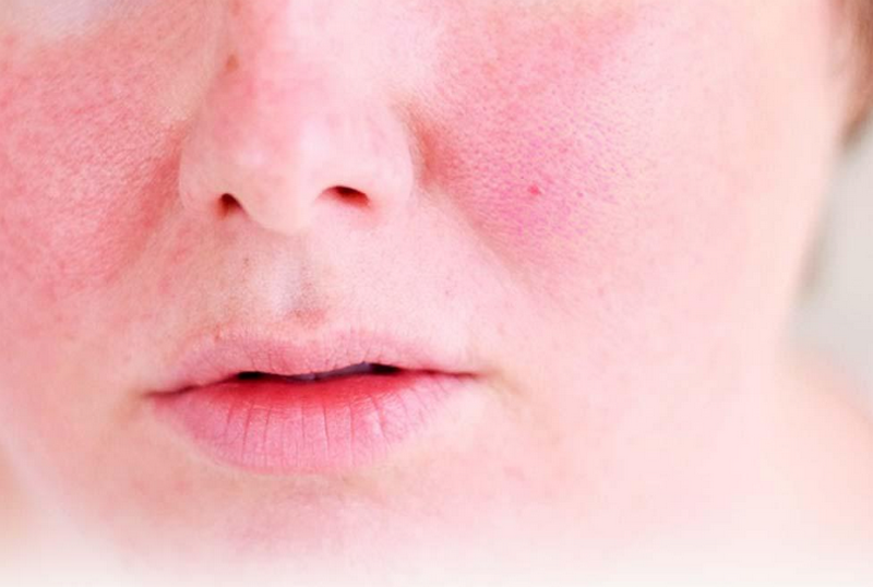 Biến chứng tiêm meso: Những rủi ro cần biết trước khi làm đẹp