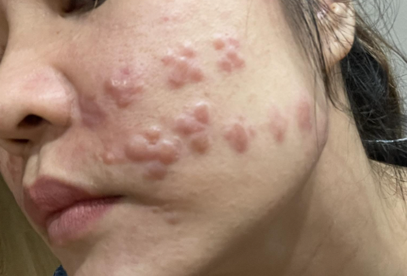 Biến chứng tiêm meso: Những rủi ro cần biết trước khi làm đẹp