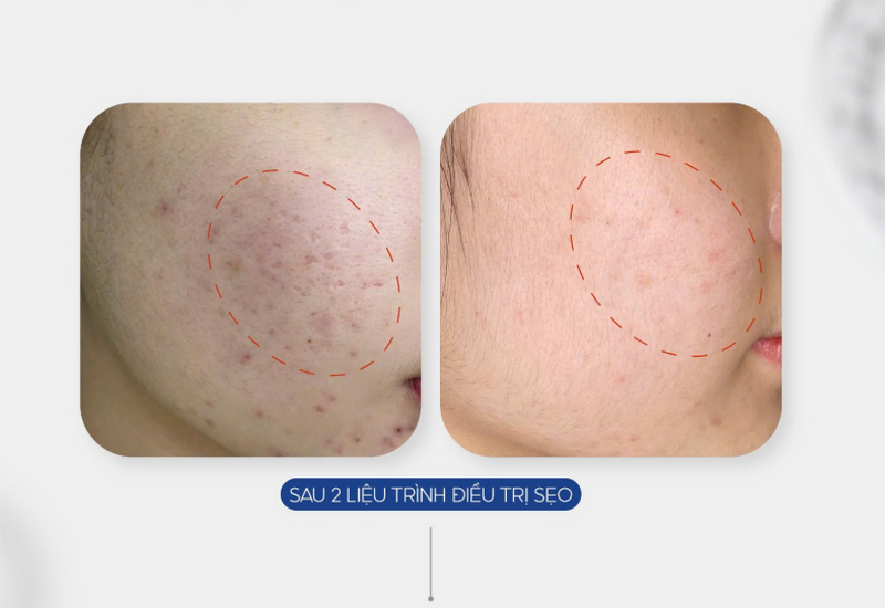 Rejuran S là chất gì? Tác dụng và những lưu ý an toàn