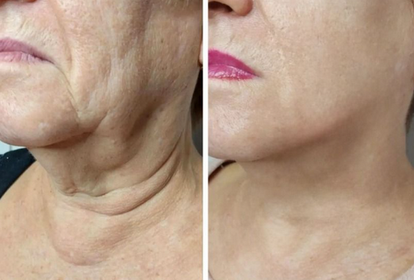 Tiêm meso có tốt không? Hiệu quả thực tế, lợi ích – rủi ro