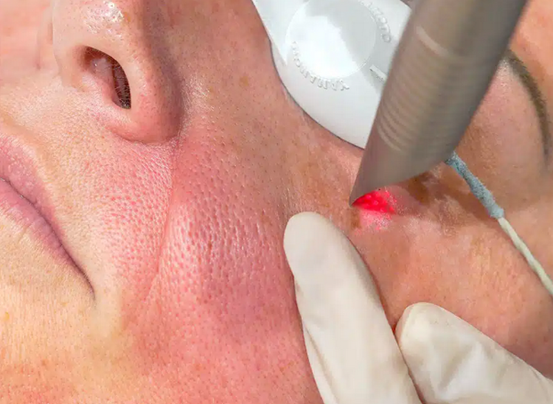 Tổng quan về công nghệ laser Fotona: công dụng, ưu nhược điểm, có an toàn?