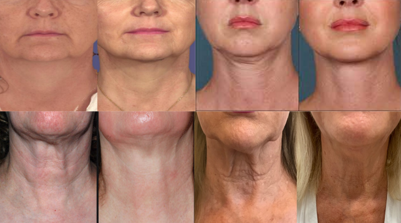 Laser Fotona 4d: Cơ chế, công dụng, có nên sử dụng không