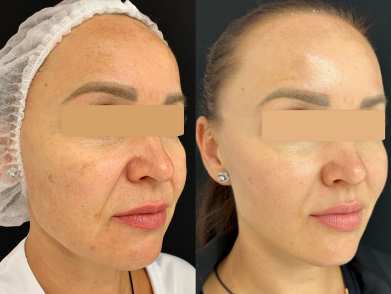 Filler là gì? Cơ chế, tác dụng và ưu nhược điểm