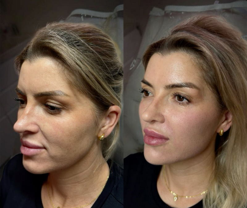 Filler Dermalax của nước nào, có tốt không?