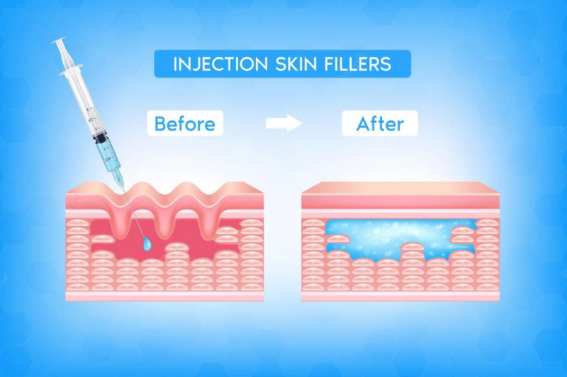 Filler Dermalax của nước nào, có tốt không?