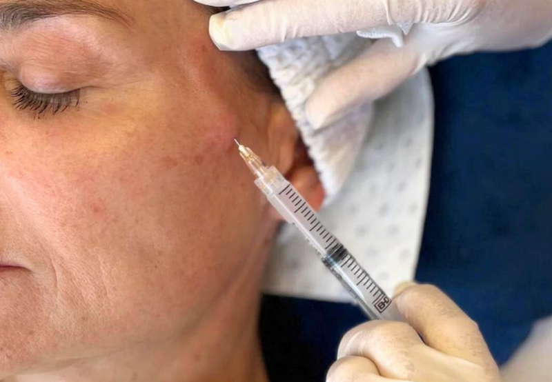 Skin Boosters là gì? Ưu nhược điểm và cách sử dụng hiệu quả