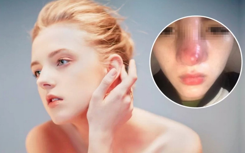 Hậu quả của nâng mũi khi về già và cách phòng tránh