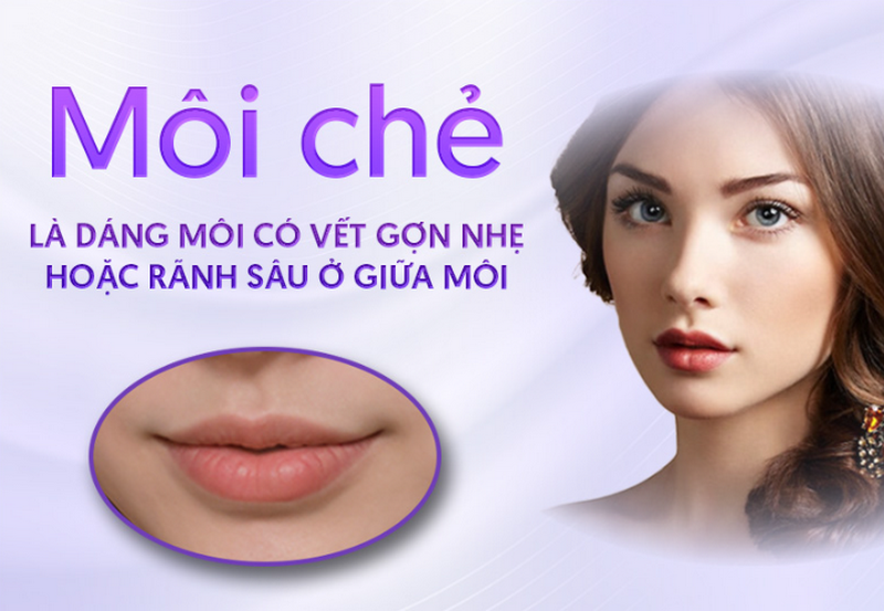Môi chẻ là gì? Đặc điểm nhận biết và góc nhìn thẩm mỹ hiện đại