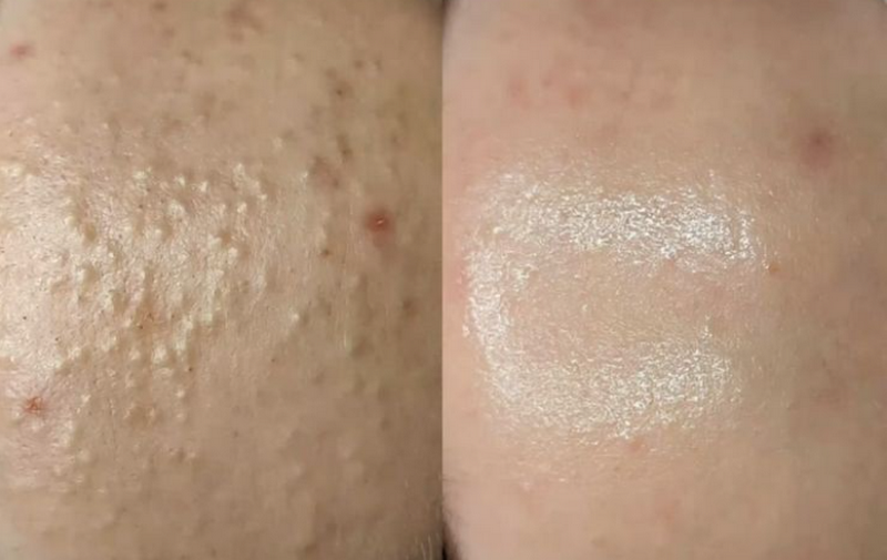 Laser Nd YAG là công nghệ laser thẩm mỹ phổ biến trên thị trường.